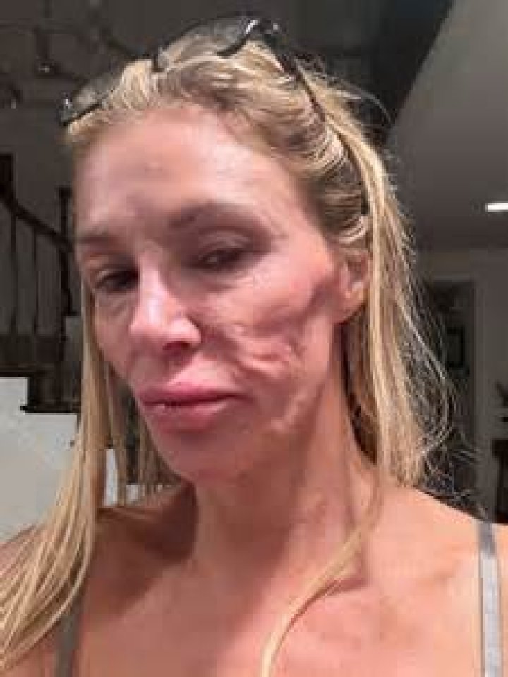 Plastic Surgeon Breaks Down Brandi Glanville's NSFW Liposuction Procedure