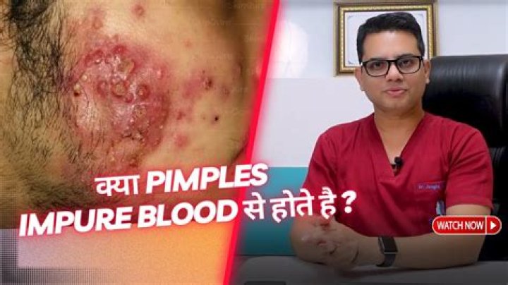 Why do pimples squirt? - BlogInfo